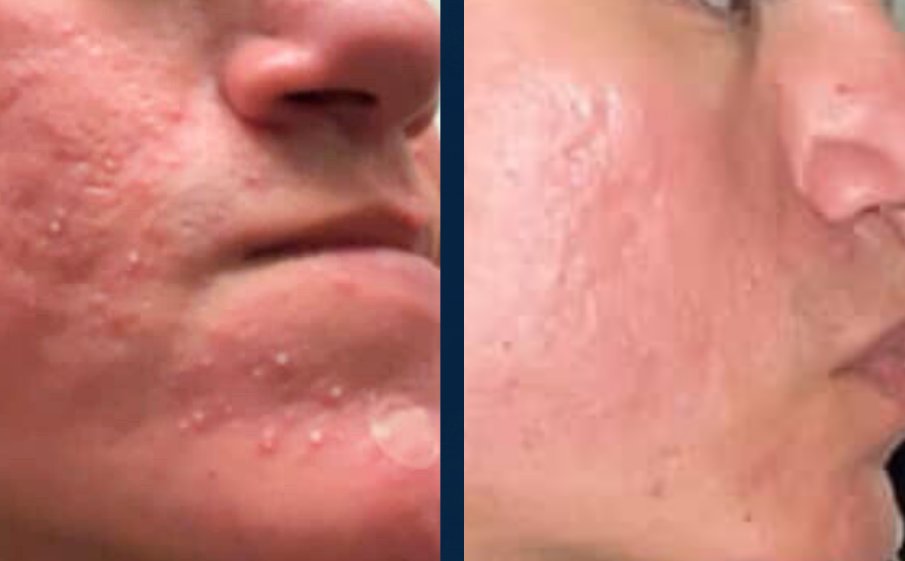 Before and after, red breakouts on the cheek and jaw