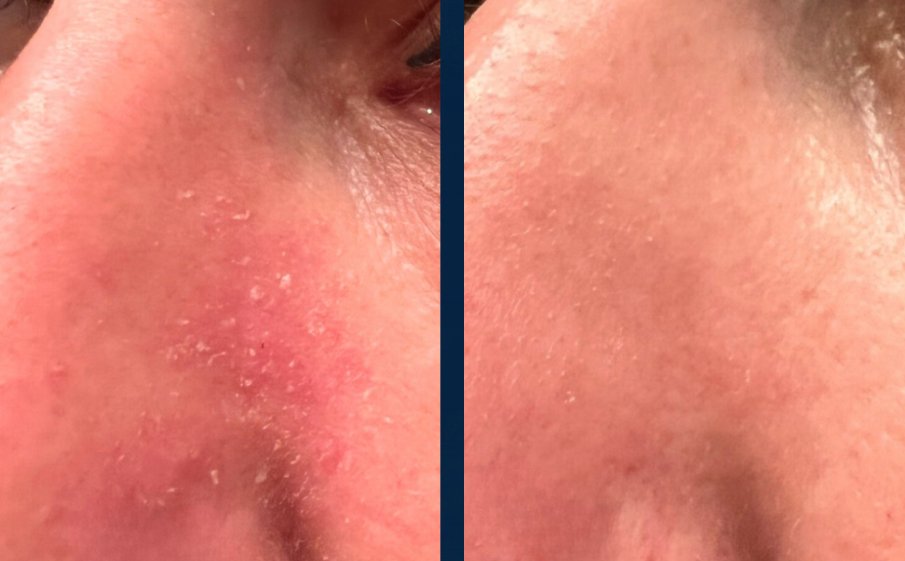 Customer before and after, red flaking skin beside the nose