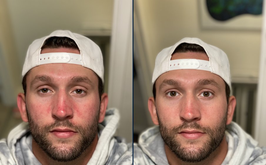 Kevin Niehoff before and after, cheek and nose redness