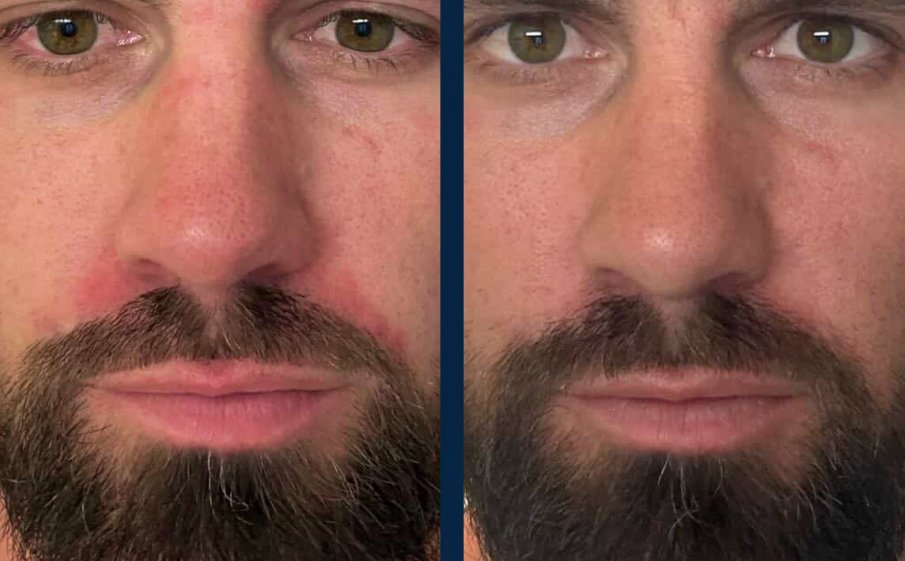 Customer before and after, redness beside the nose and brows