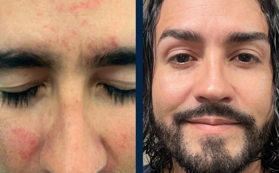 Customer before and after, red spots on the forehead