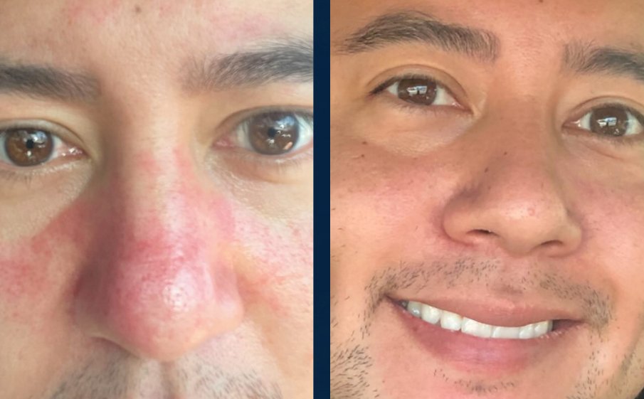 Customer before and after, red nose and cheeks