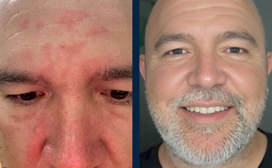 Customer before and after, forehead and nose redness