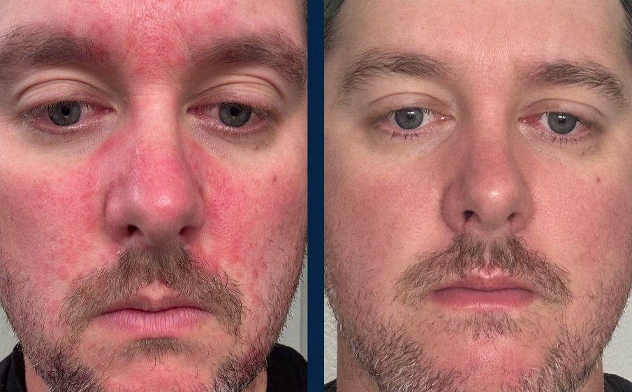 Customer before and after, red patches on forehead, cheeks and nose