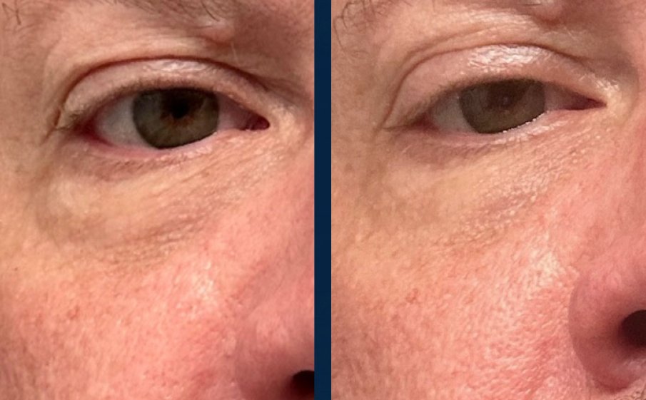 Customer before and after, under-eye puffiness and creasing